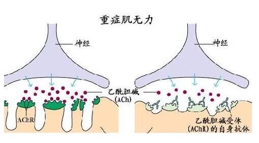 菲总统患上重症肌无力，干细胞疗法为他带来新希望！