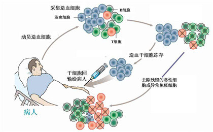 目前根治白血病最有效的方法——造血干细胞移植治疗